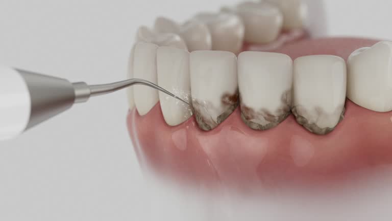 Trusted Dental Crowns And Bridges service in Richfield, MN - Dentist Open Now